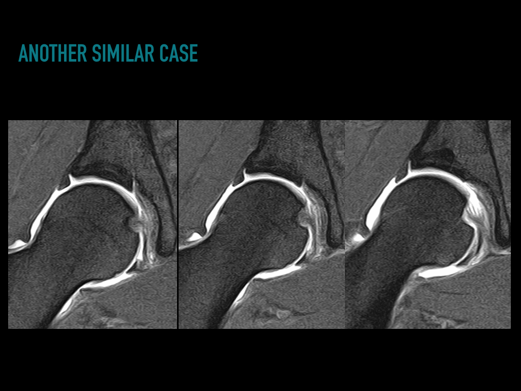 Figure 3 for case Sublabral sulcus